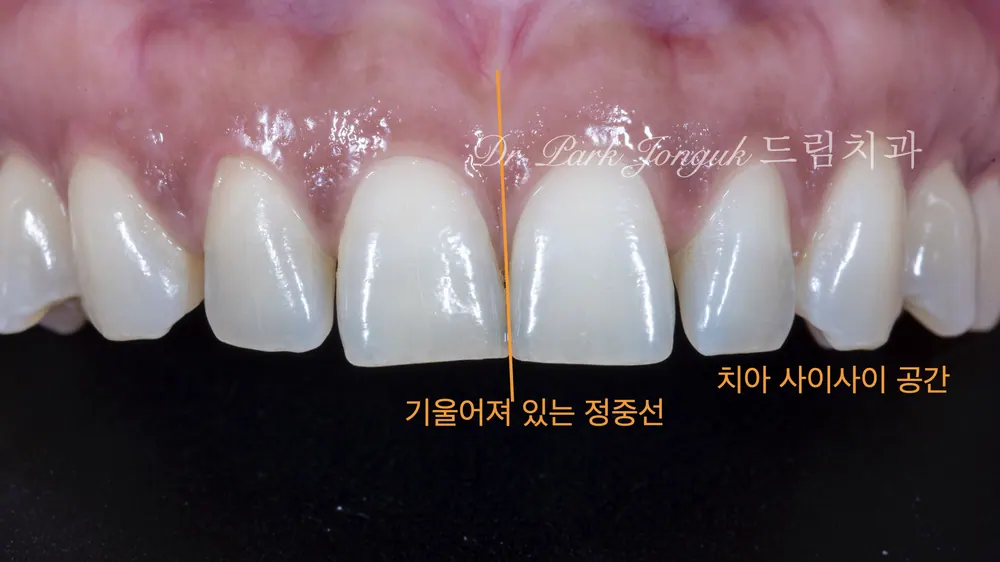압구정라미네이트 벌어진 치아의 라미네이트 치료 본문 사진 2