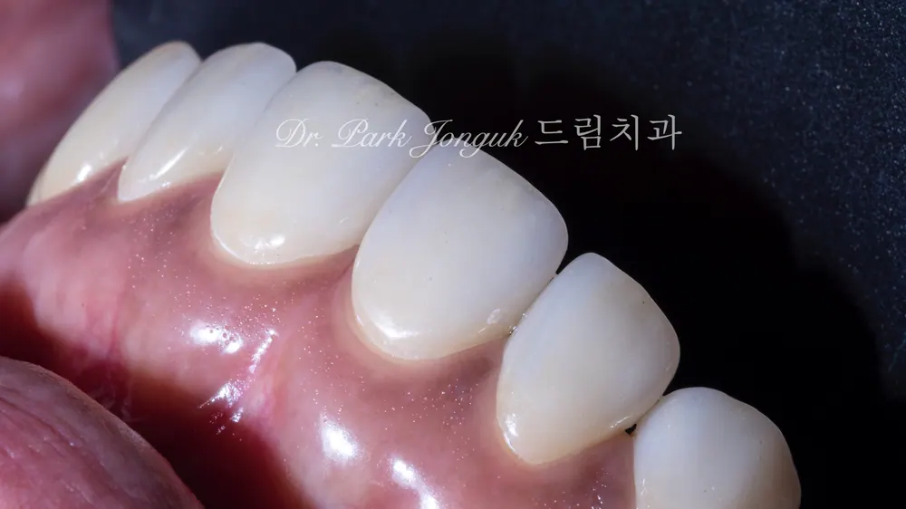 압구정라미네이트 벌어진 치아의 라미네이트 치료 본문 사진 9