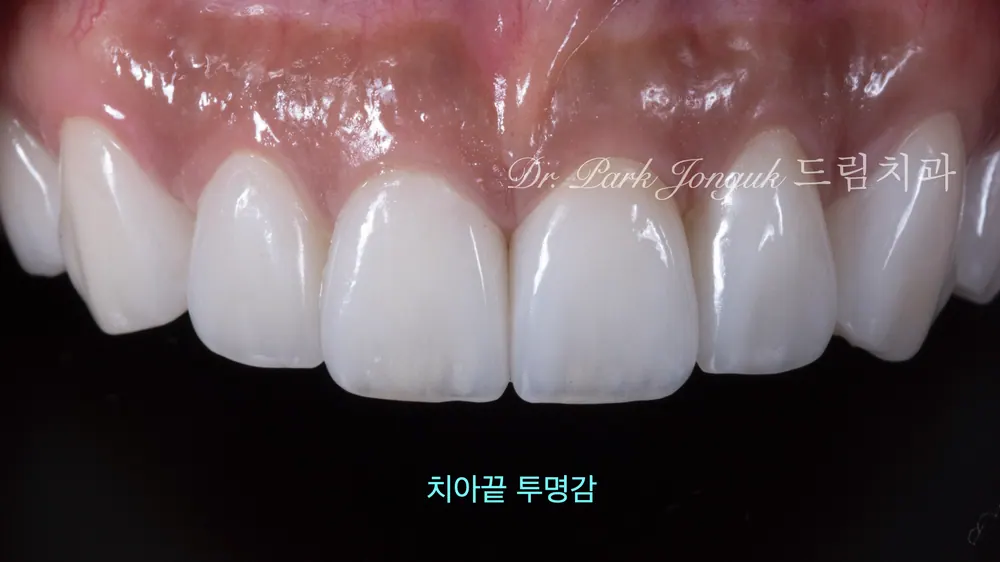 청담역라미네이트 더 고르고 자연스럽게 치료한 사례 본문 사진 4