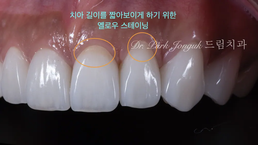 청담역라미네이트 더 고르고 자연스럽게 치료한 사례 본문 사진 6