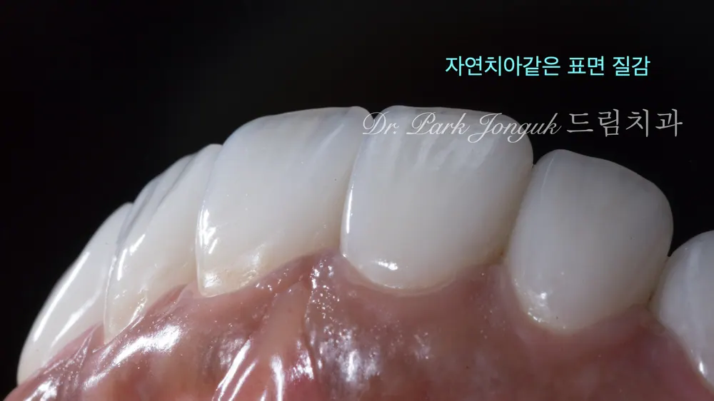 청담역라미네이트 더 고르고 자연스럽게 치료한 사례 본문 사진 8