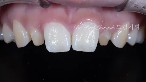 라미네이트 잘하는치과 왜소치, 큰 치아를 자연스럽게 라미네이트로 치료하기