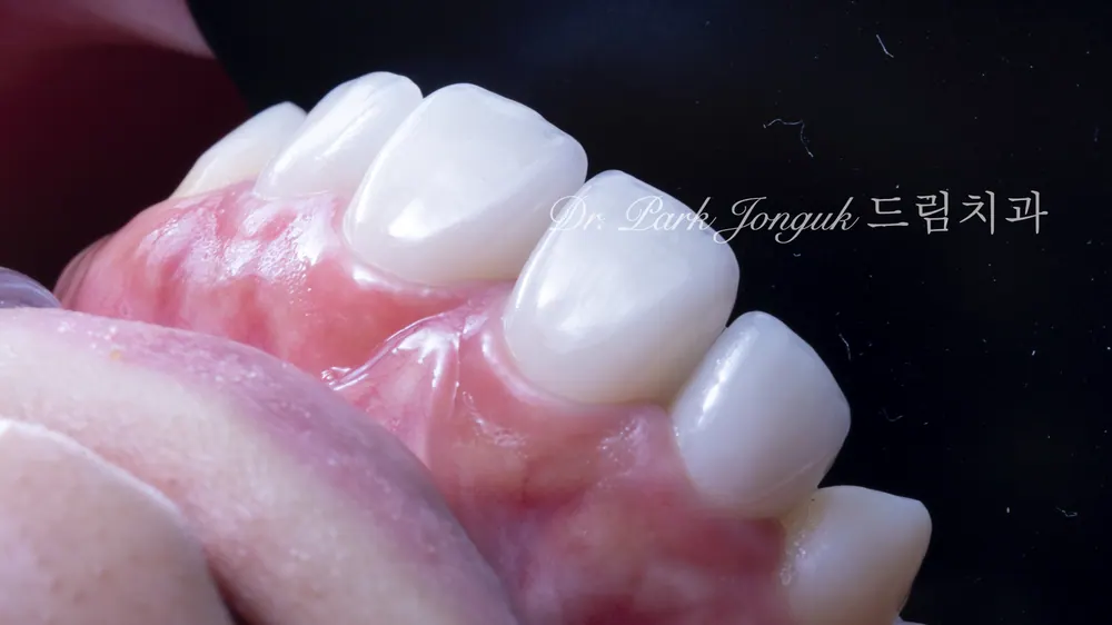 벌어진 앞니, 라미네이트로 재시술하기 본문 사진 10