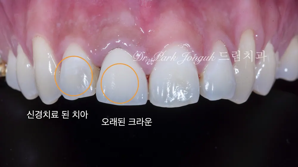 올세라믹 크라운 재시술과 앞니 라미네이트 치료 본문 사진 3