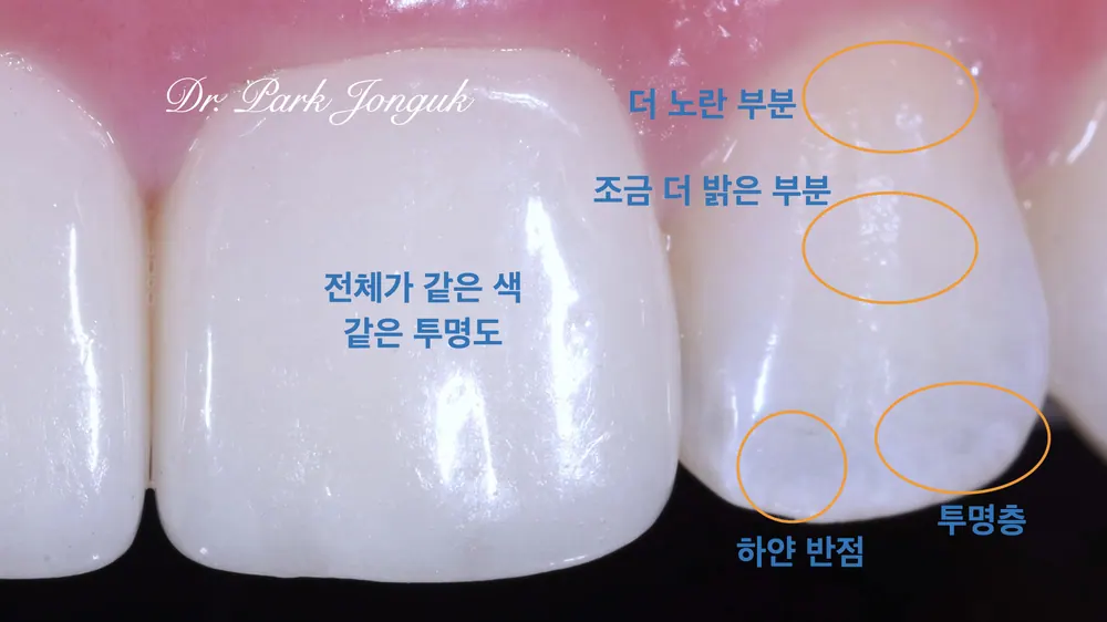 어색하고 인공적인 앞니 라미네이트를 자연스럽게 재시술 하기 본문 사진 3