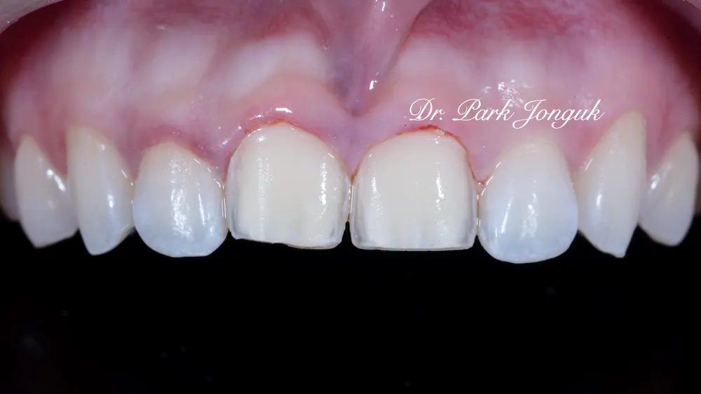어색하고 인공적인 앞니 라미네이트를 자연스럽게 재시술 하기 본문 사진 5