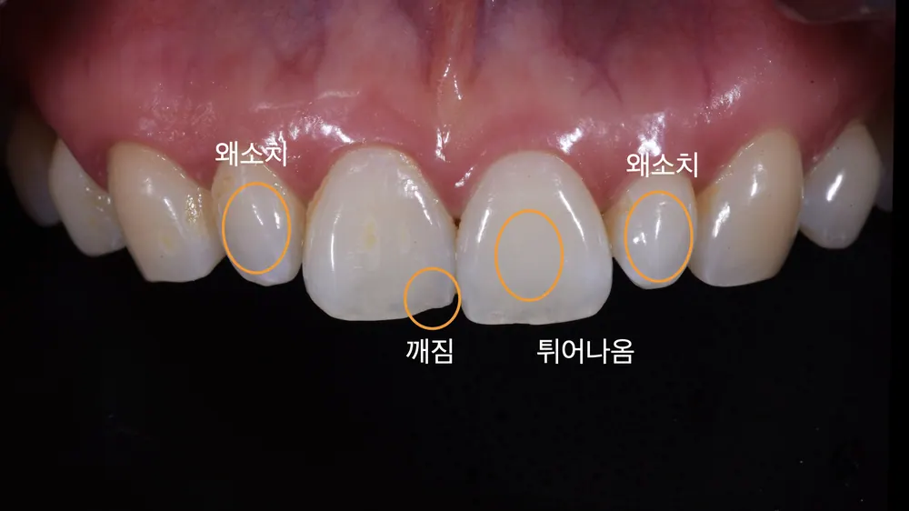 틀어진 치열, 왜소치를 바로잡는 앞니 라미네이트 치료 본문 사진 2