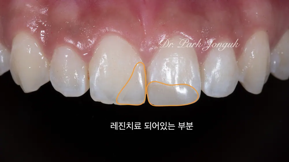 변색된 레진, 앞니 라미네이트로 해결하기 본문 사진 2