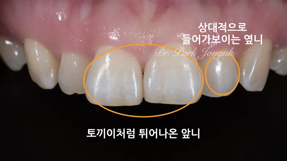 신사치과 토끼이를 앞니 라미네이트로 아름답게 본문 사진 2