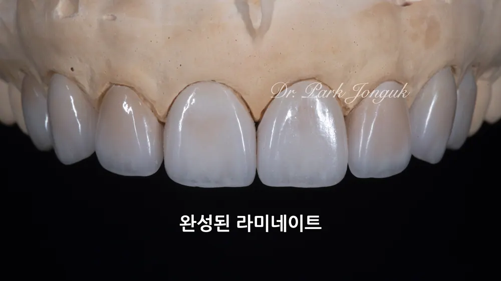 신사치과 토끼이를 앞니 라미네이트로 아름답게 본문 사진 3