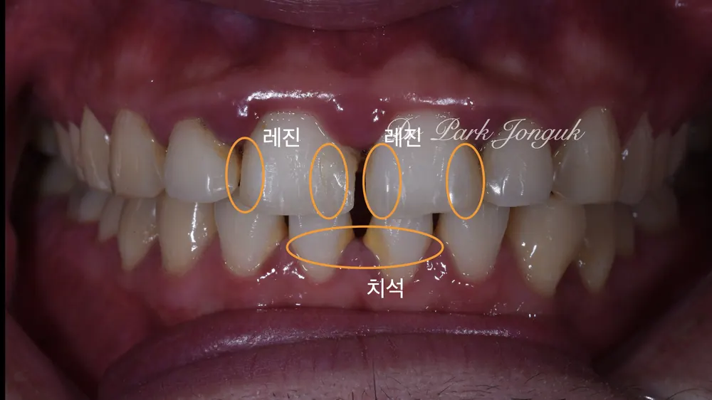 신사라미네이트 벌어진 치아, 잇몸 염증 앞니 라미네이트로 아름답게 본문 사진 2
