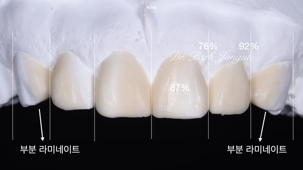 무삭제 라미네이트 자연스러운 느낌을 살려 시술 진행 본문 사진 5