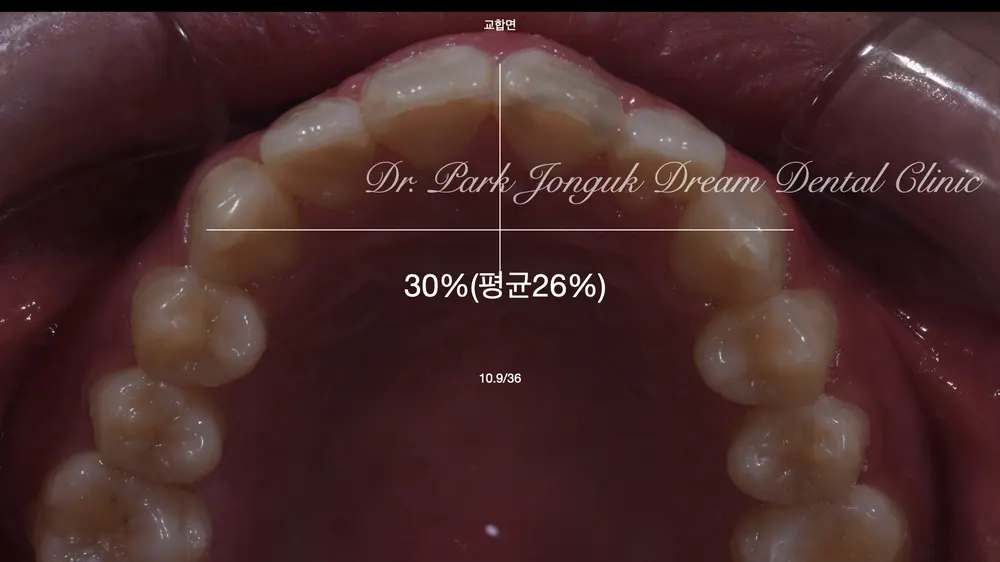 압구정역 치과 앞니 라미네이트 치료한 사례 본문 사진 5