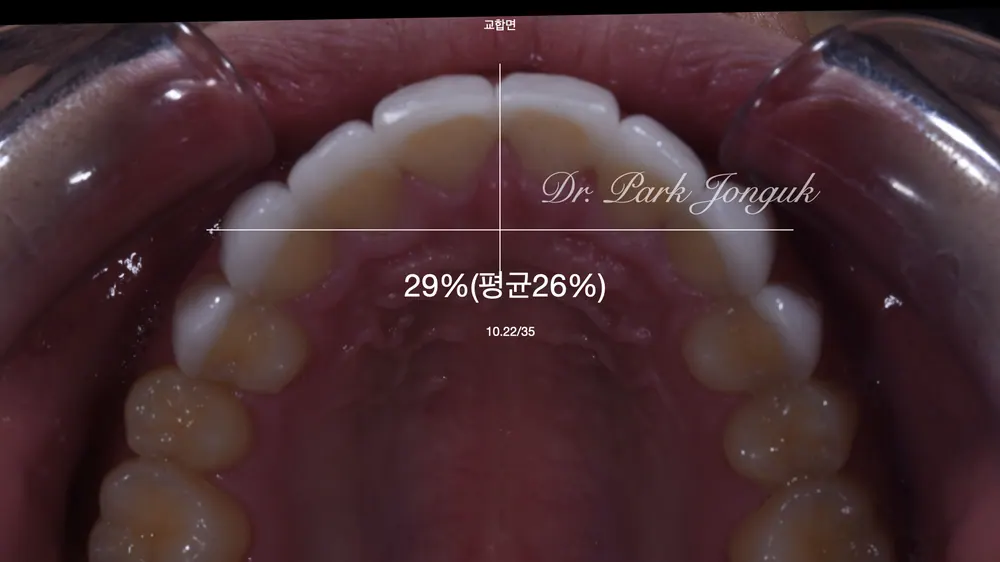오래된 앞니 라미네이트 재시술 잘하는 곳 본문 사진 3