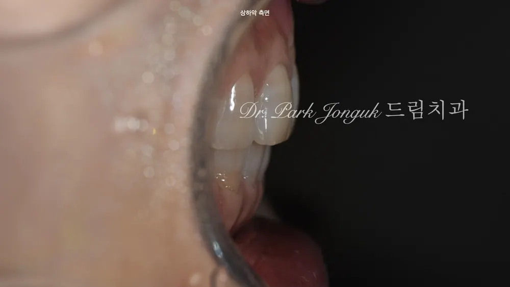 아름다운 비율을 위한 앞니 라미네이트 치료 본문 사진 3