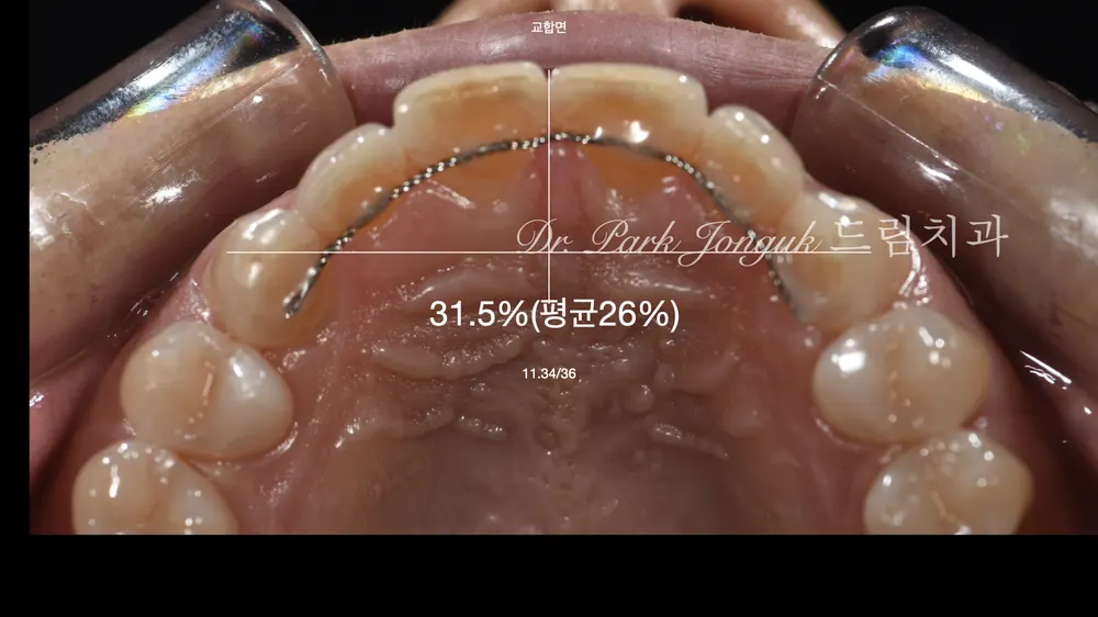 아름다운 비율을 위한 앞니 라미네이트 치료 본문 사진 4