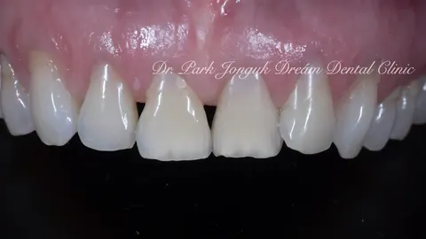 청담동치과 블랙트라이앵글의 라미네이트 치료
