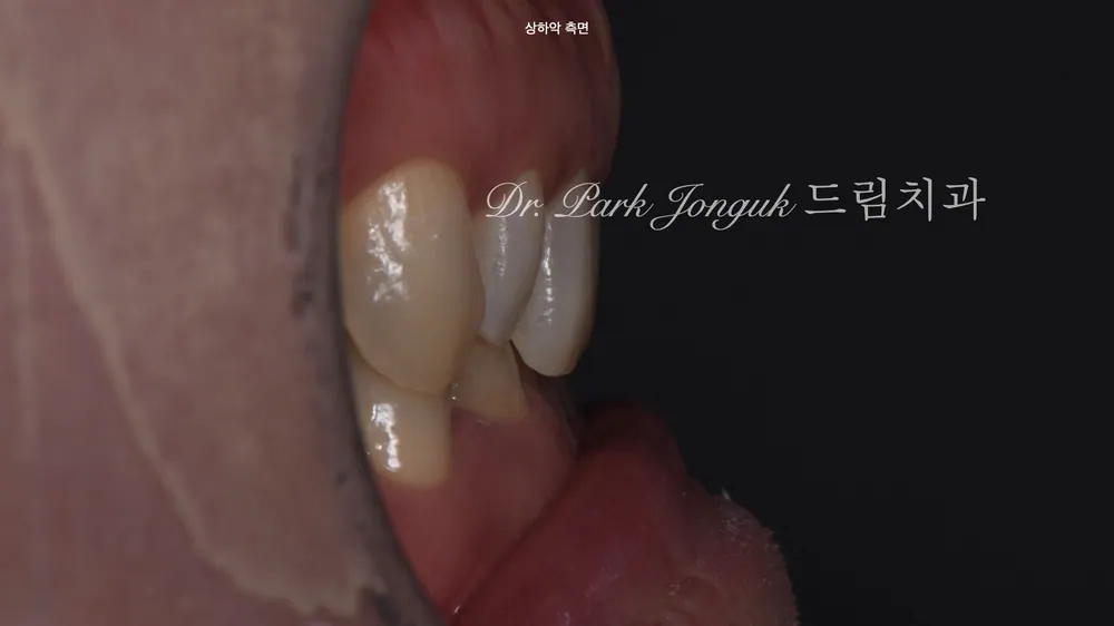 신사동라미네이트 벌어진 앞니의 라미네이트 치료 본문 사진 3