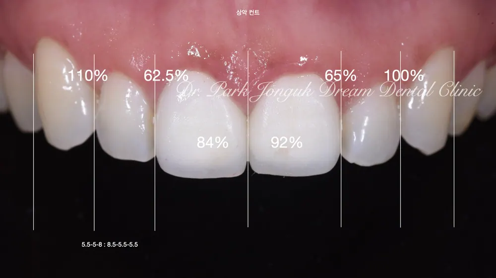 자연스러운 앞니 라미네이트, 올세라믹 크라운을 위한 재시술 본문 사진 2