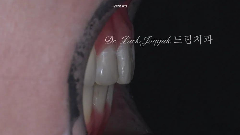 무삭제 라미네이트 부작용을 줄이는 방법 본문 사진 3