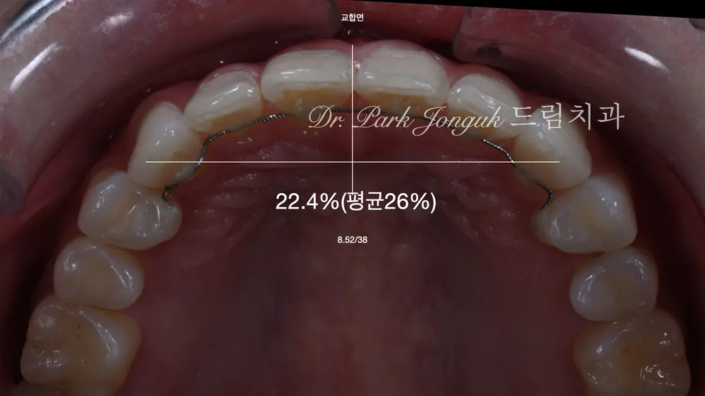 무삭제 라미네이트 부작용을 줄이는 방법 본문 사진 4