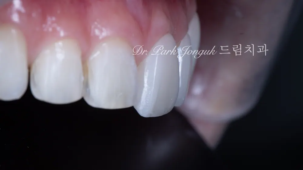 무삭제 라미네이트 부작용을 줄이는 방법 본문 사진 10