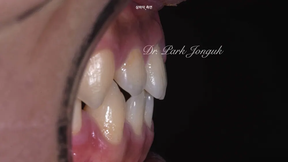 연예인라미네이트 무삭제로 자연스럽게 치료 진행 본문 사진 4