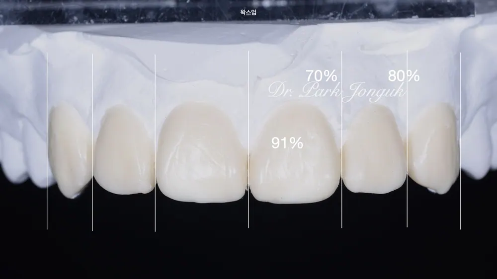 연예인라미네이트 무삭제로 자연스럽게 치료 진행 본문 사진 5