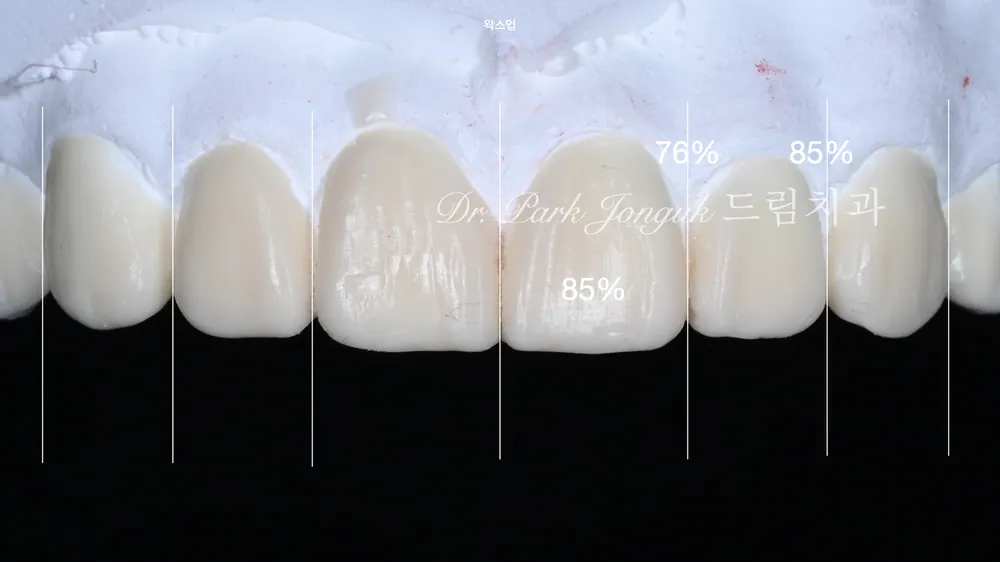연예인 라미네이트 어색하지 않게 진행하기 본문 사진 4