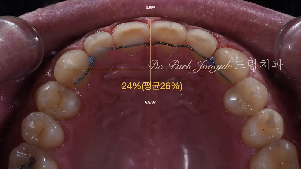 역류성 식도염이나 산성 음식에 의한 부식의 무삭제 라미네이트 본문 사진 3