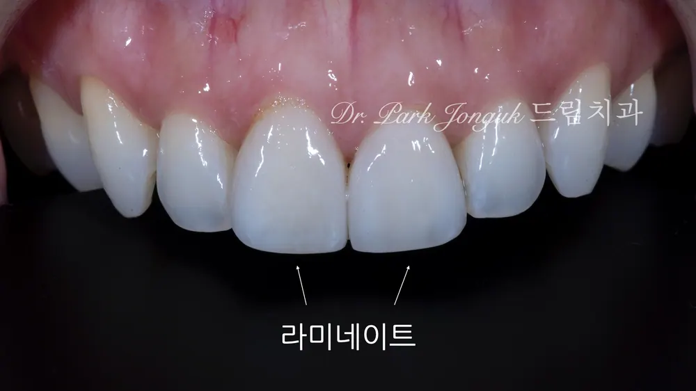 라미네이트재시술 무삭제로 진행한 사례 본문 사진 2