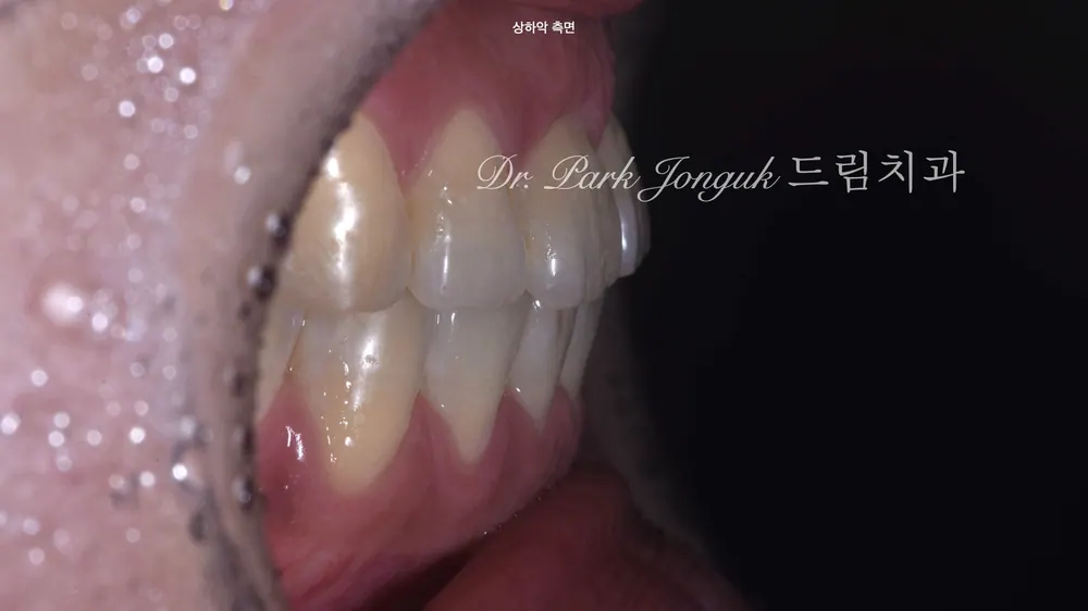 압구정치과 무삭제 라미네이트 잘하는 곳 본문 사진 3
