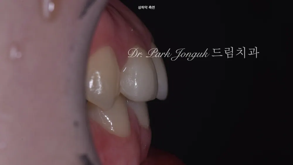 자연스럽게 라미네이트 재시술하기 본문 사진 3