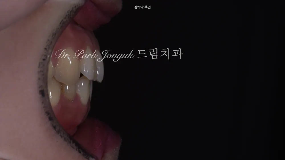 앞니라미네이트 심미성 높일 수 있어 본문 사진 3