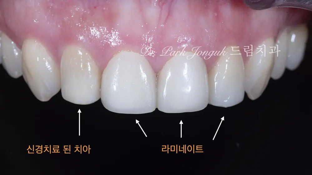 신사동치과 자연스러운 느낌으로 라미네이트 재시술 본문 사진 2