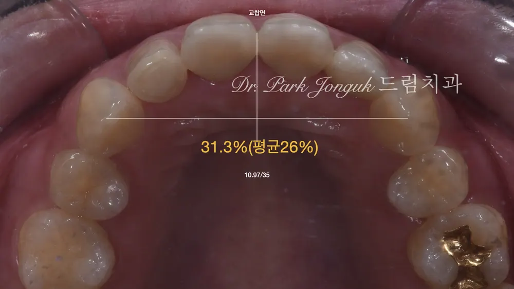 신사동치과 자연스러운 느낌으로 라미네이트 재시술 본문 사진 5