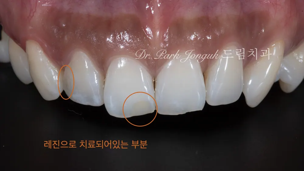 치아의 형태와 배열을 바로잡는 앞니 라미네이트 본문 사진 2