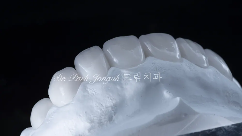 라미네이트잘하는곳 무삭제 라미네이트 치료한 사례 본문 사진 8