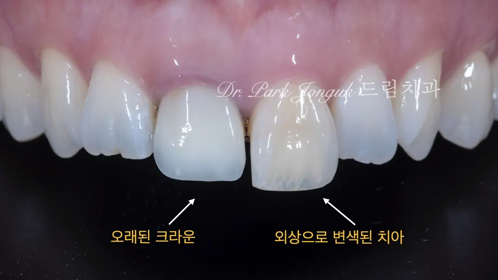 압구정동치과 올세라믹 크라운의 재시술과 라미네이트 치료 본문 사진 2