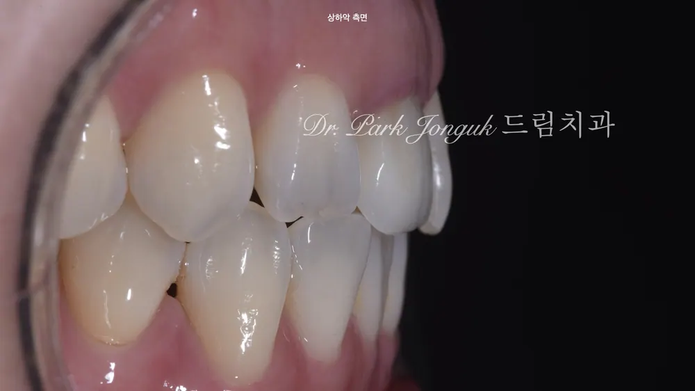 압구정동치과 올세라믹 크라운의 재시술과 라미네이트 치료 본문 사진 4