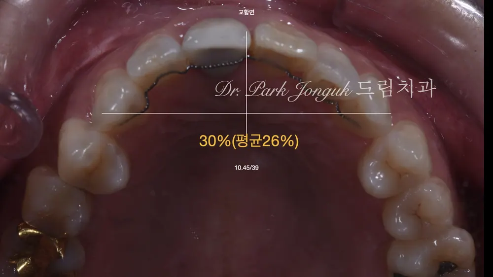 압구정동치과 올세라믹 크라운의 재시술과 라미네이트 치료 본문 사진 5