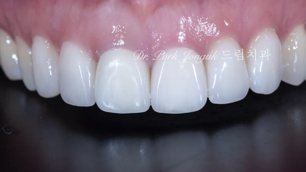 압구정동치과 올세라믹 크라운의 재시술과 라미네이트 치료 본문 사진 8