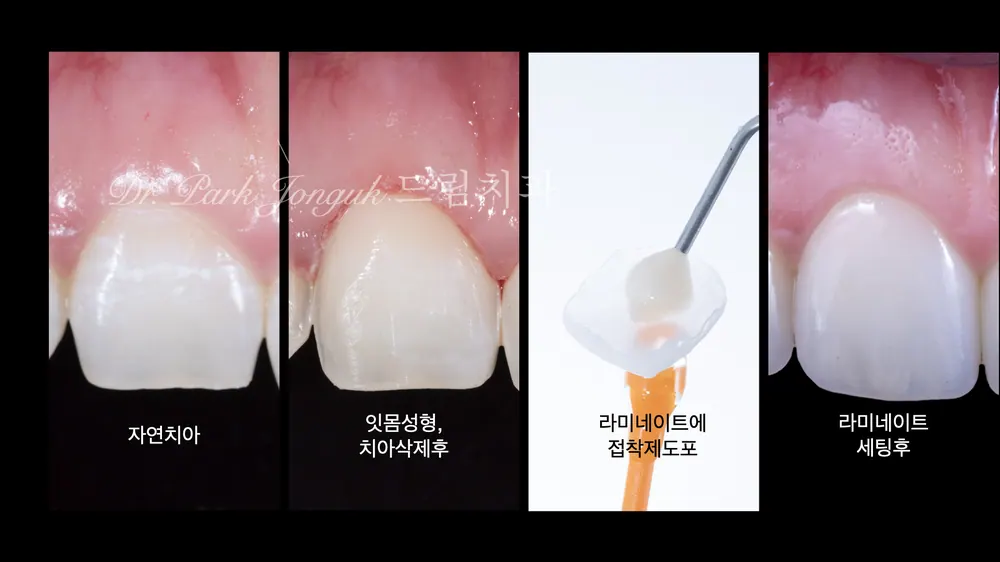 라미네이트치과 올세라믹 크라운 재시술 본문 사진 1