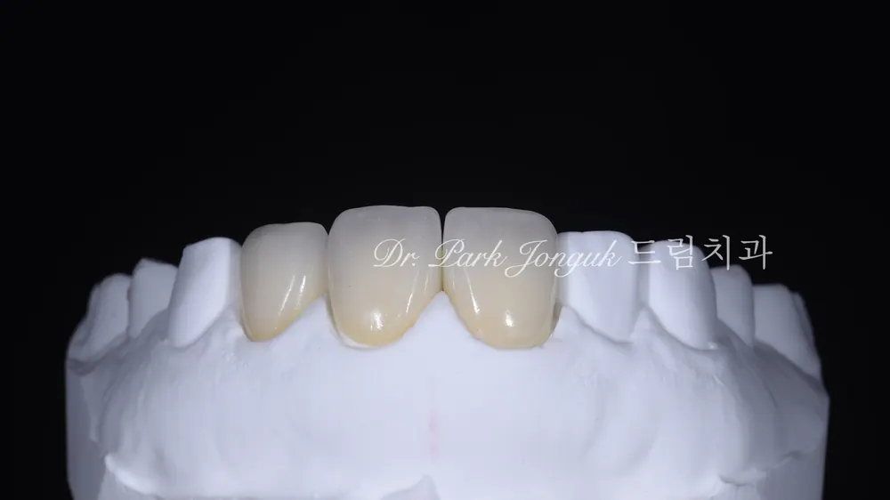 압구정라미네이트 치아 손상을 최소화한 시술 본문 사진 15