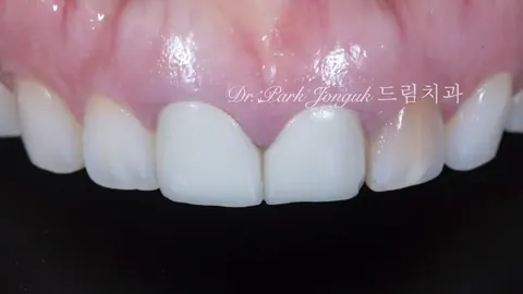 압구정라미네이트 치아 손상을 최소화한 시술