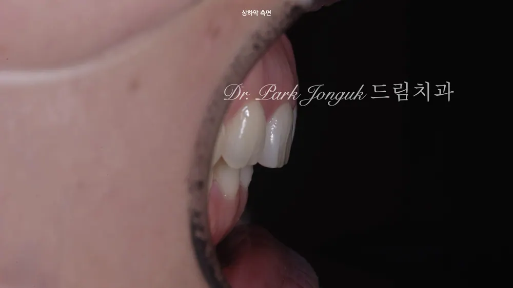 부작용을 줄이는 미세삭제 라미네이트 본문 사진 3