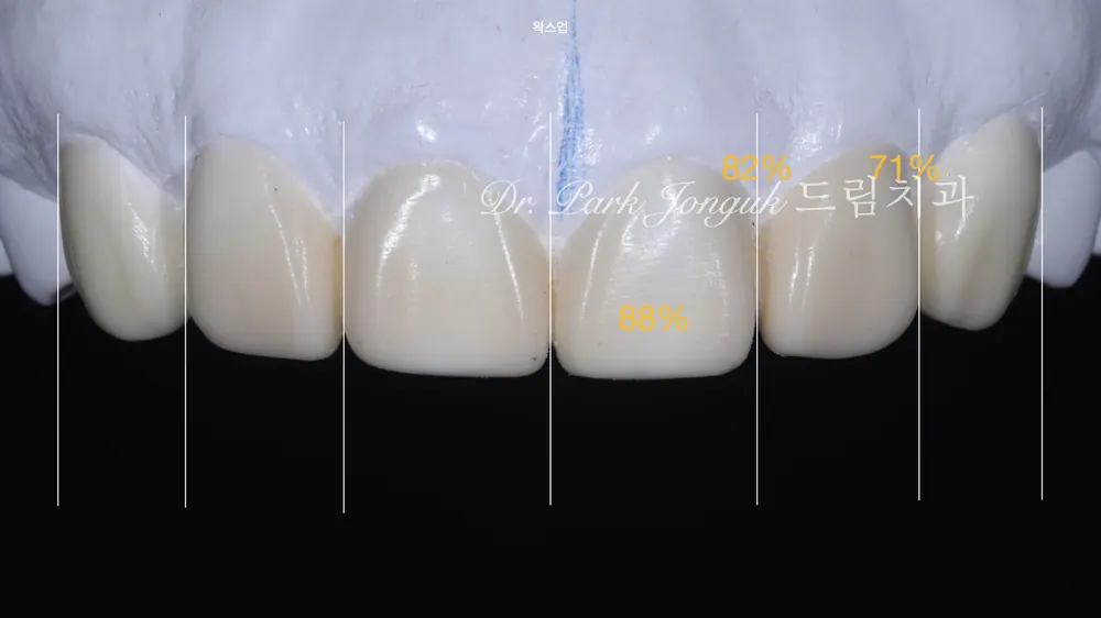 부작용을 줄이는 미세삭제 라미네이트 본문 사진 5