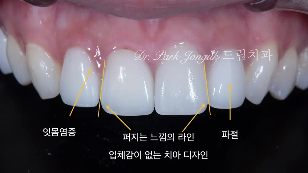 라미네이트 부작용 재시술이 필요할 때는 본문 사진 2