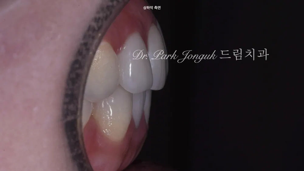 라미네이트 부작용 재시술이 필요할 때는 본문 사진 4