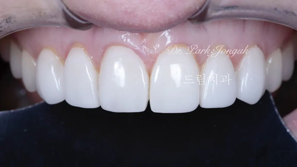 부자연스럽고 어색한 라미네이트의 재시술 본문 사진 1